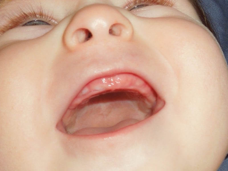 When Does Babies Start Developing Teeth?